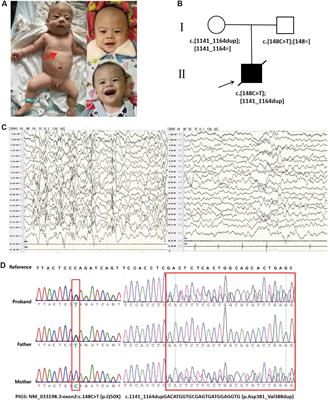 Compound Heterozygous PIGS Variants Associated With Infantile Spasm, Global Developmental Delay, Hearing Loss, Visual Impairment, and Hypotonia